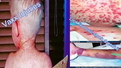 TOXIC SHOCK SYNDROME 💉 (In That Moment)