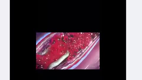 What is the MRNA Vaccine