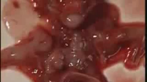 What Happens On A First Trimester Abortion