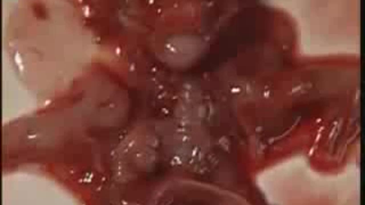 What Happens On A First Trimester Abortion