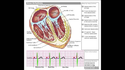 Dr Stanley's ECGcourse.com | Sinus Arrhythmia Tutorial