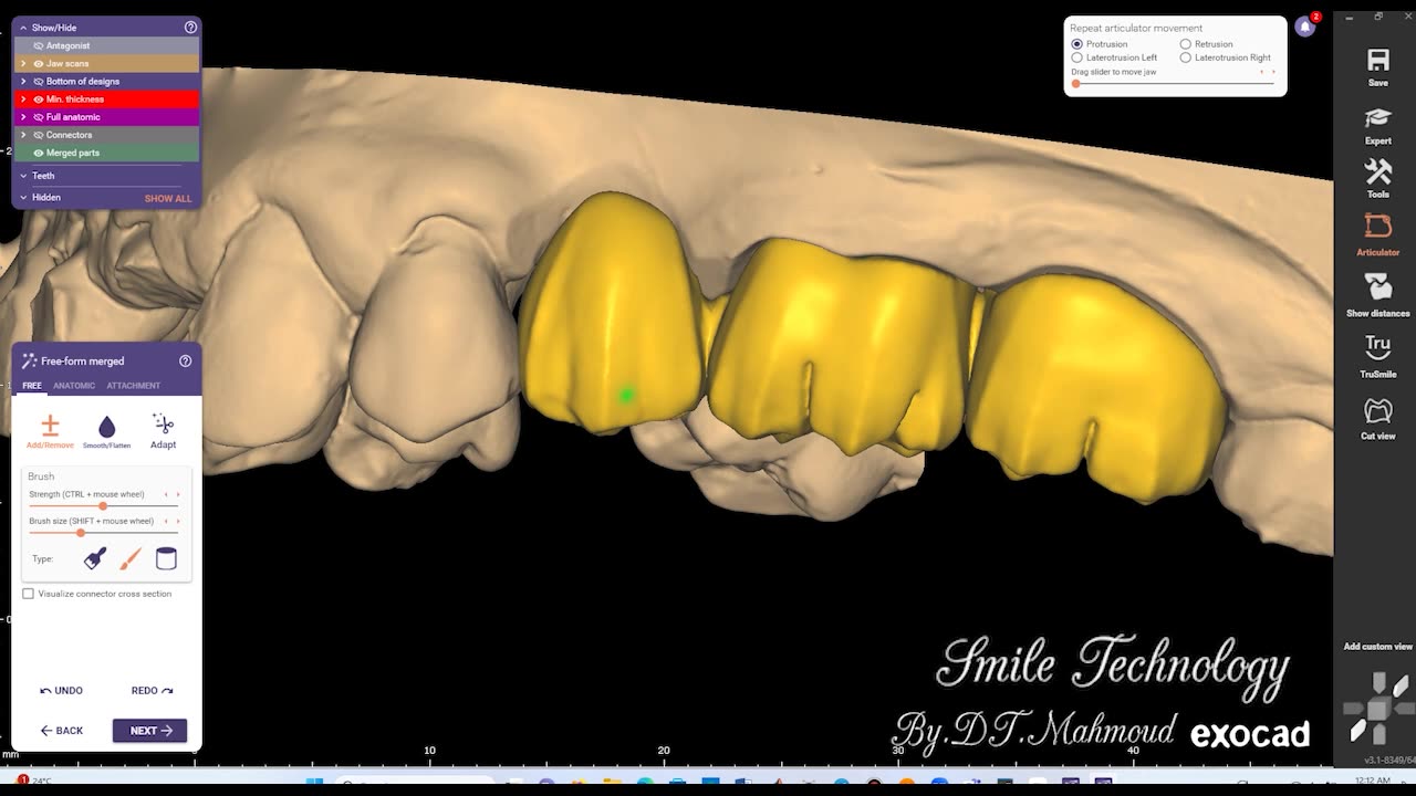 #design #naildesign #dental #dentaldesign #exocadexpert