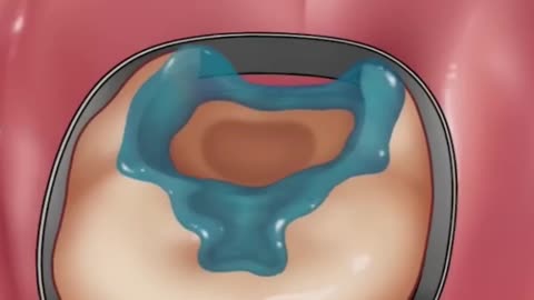 Dental Filling Process In 3D Animation