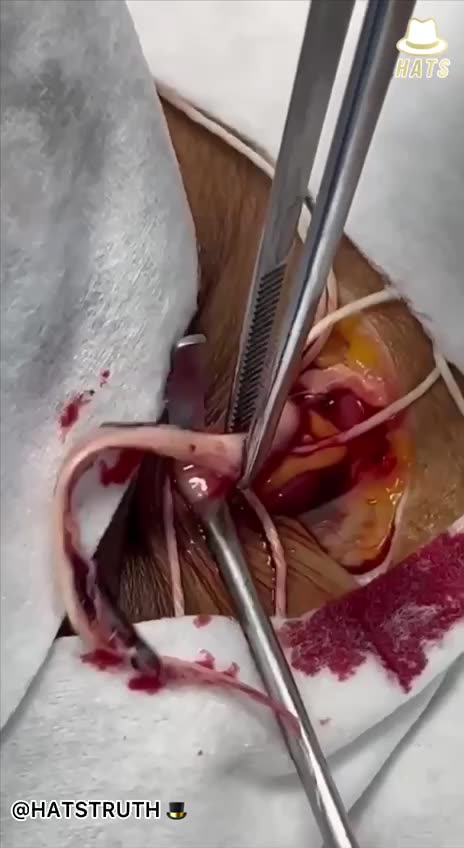 Those clots are lipid nanoparticle that have regenerated over, and over in the veins