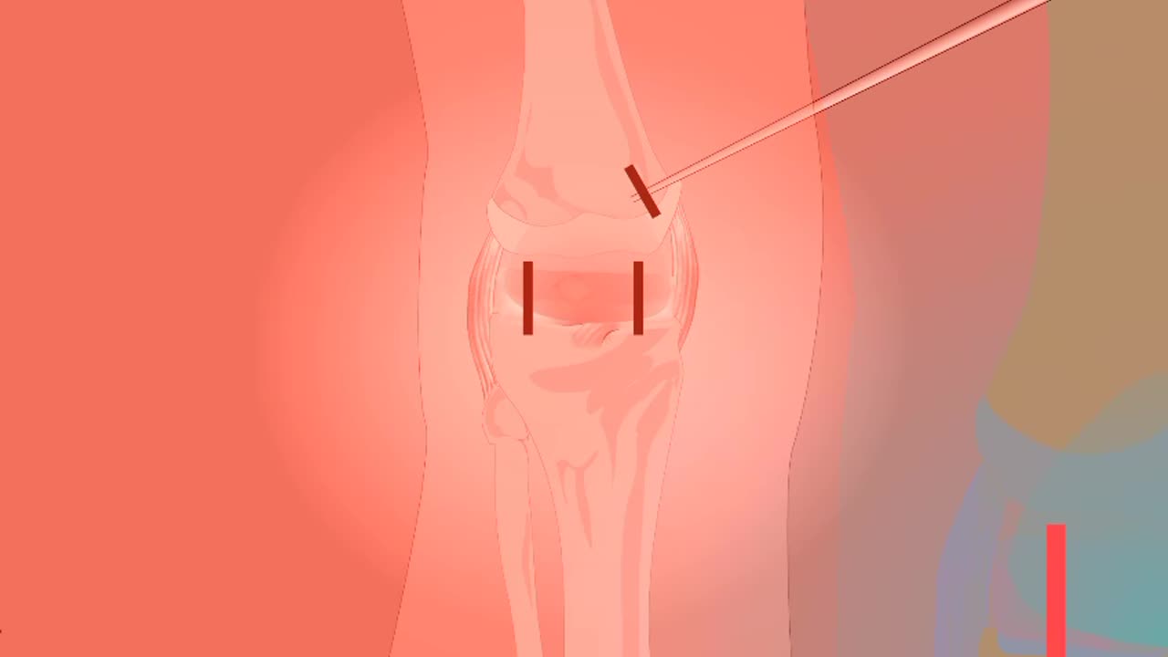 pain management of knee joint that is arthritis or rheumatoid arthritis