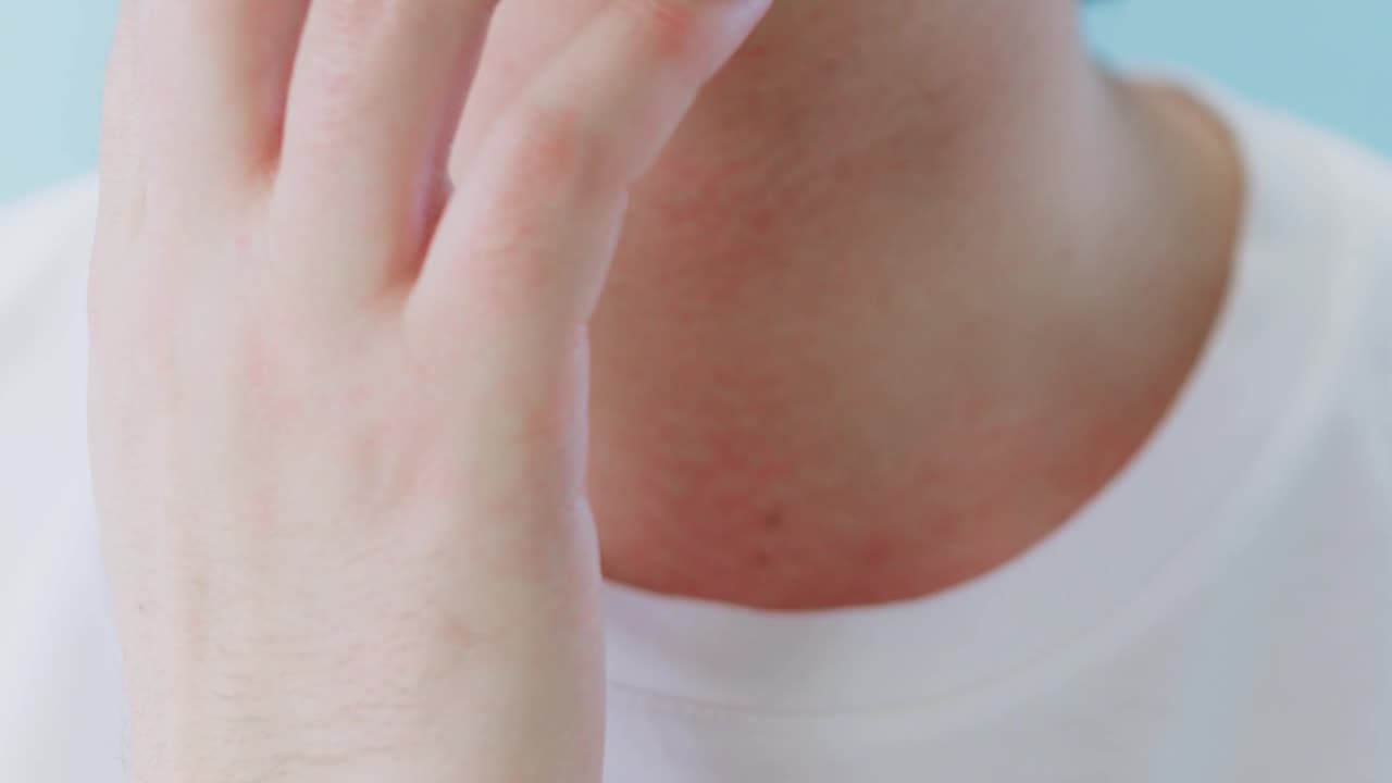 pimples problems ?