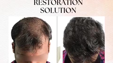 Best Hair Transplant in Ludhiana