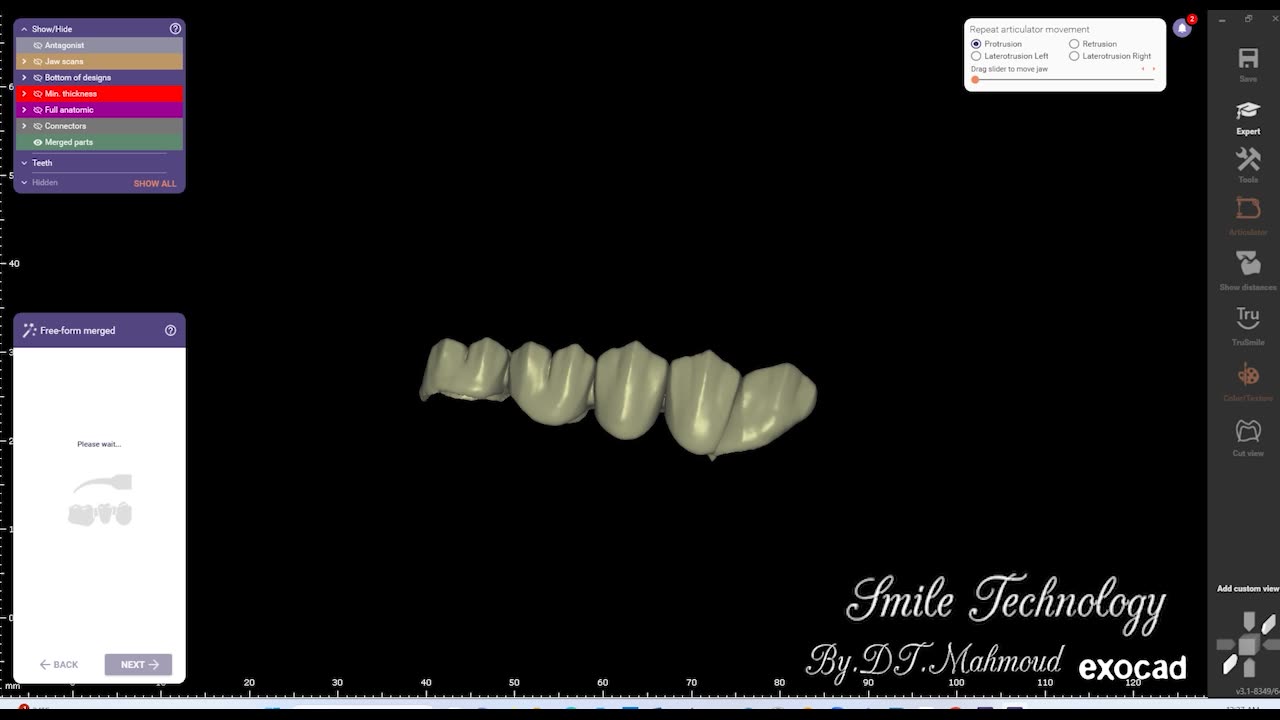 #design #naildesign #dental #dentaldesign #exocadexpert