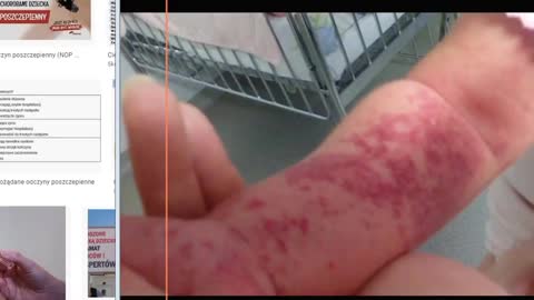 Czy elity światowe powtórzą manewr z grypą Hiszpanką eliminując szczepionkami?