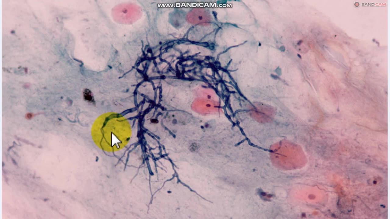 Lookoutfa Charlie- Morgellons,Lyme-Antennas