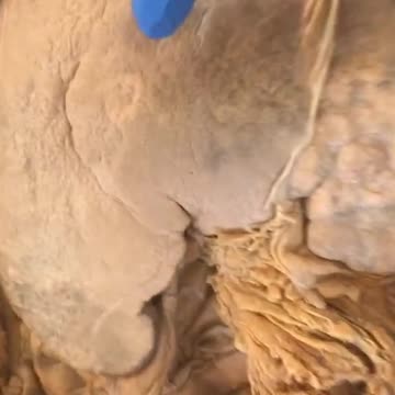 What Liver Cancer Looks Like in the Human Body