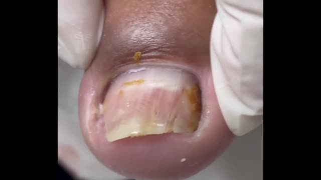 Ingrown toenail finally removed