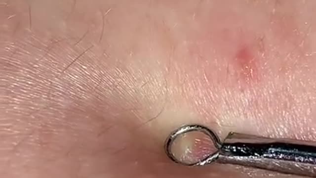 Blackhead Removal - Pimple popping - Acne Treatment - 34 #shorts