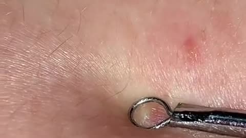 Blackhead Removal - Pimple popping - Acne Treatment - 34 #shorts