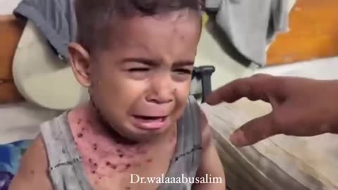 Lice, scabies, rashes plague P٨lestini٨n children as skin disease runs rampant