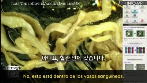 Strange fibrous clots that clog veins and arteries have been extracted from people "vaccinated"