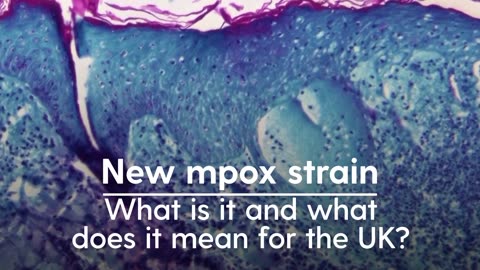 Mpox- Virus Hits in UK