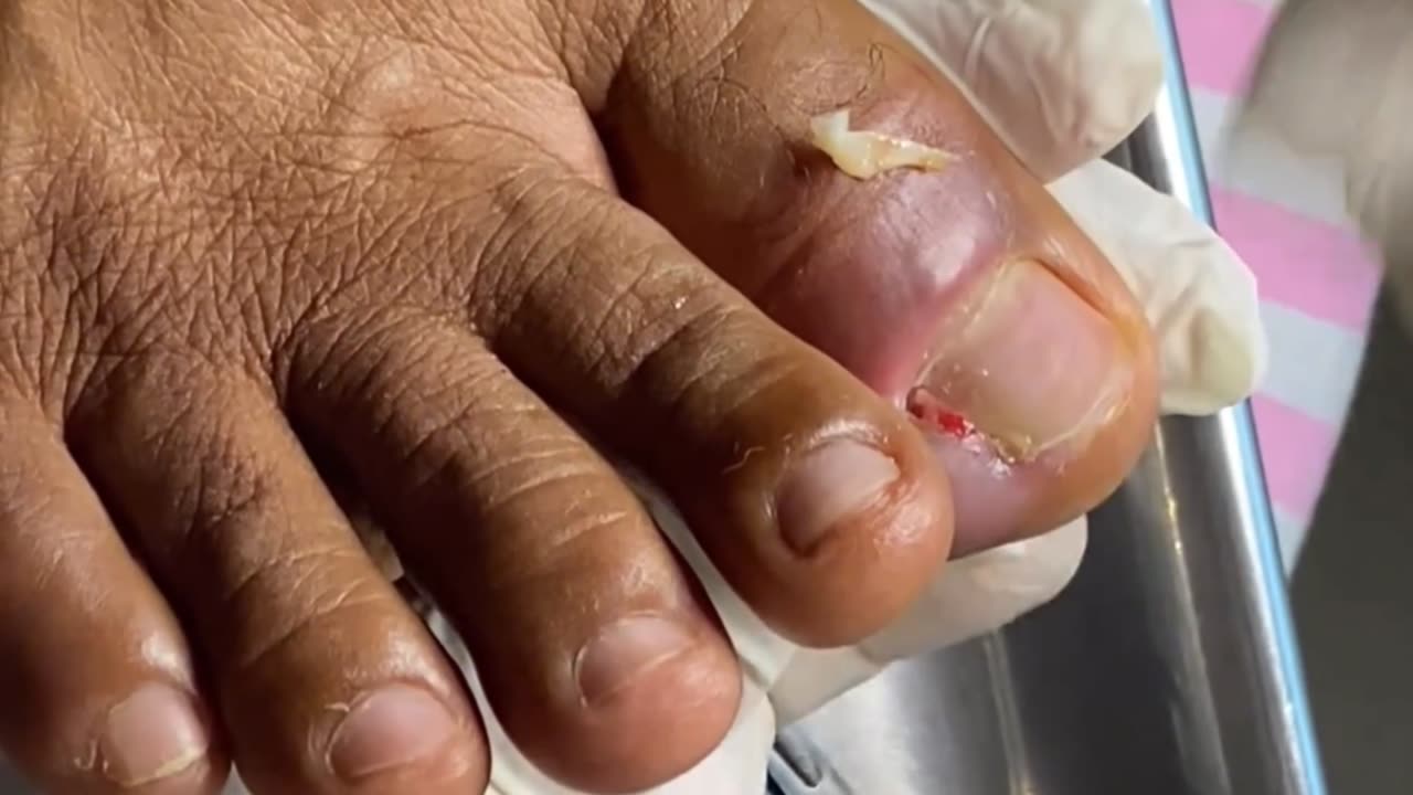 Ingrown toenail removal or kuku cantengan