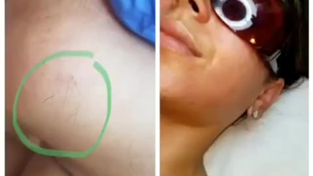 How laser hair removal is done on the chin