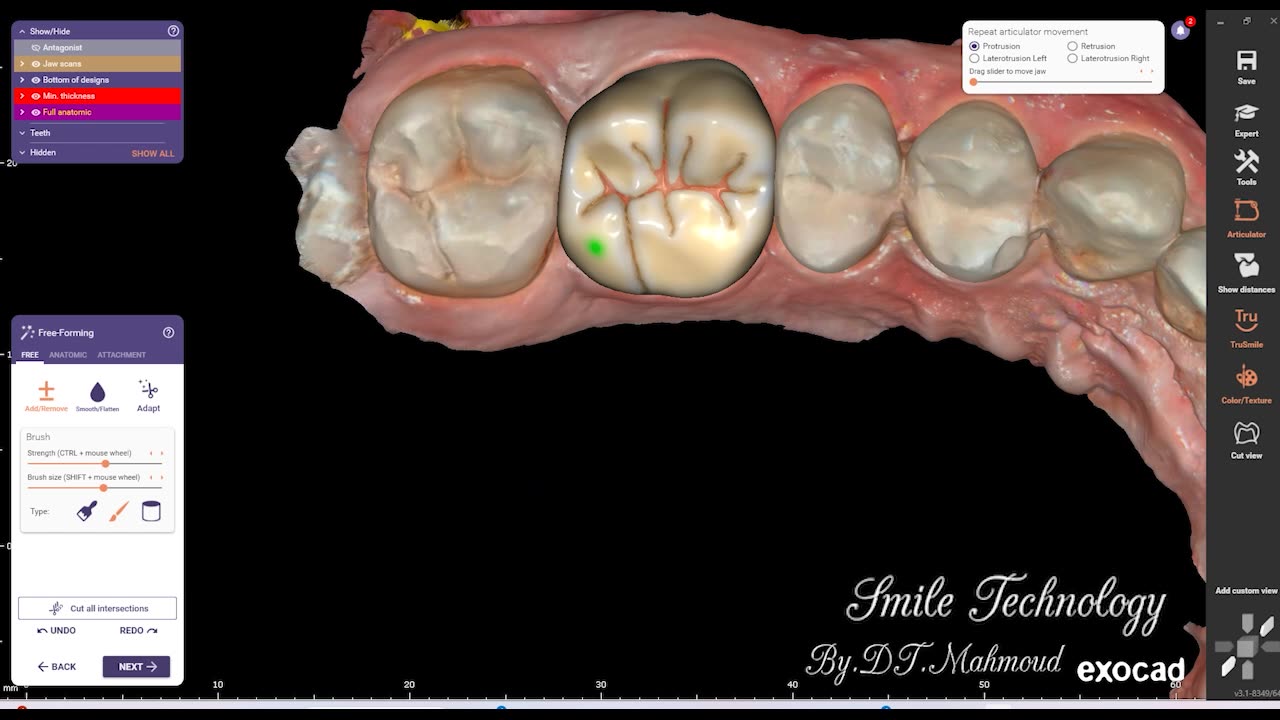 #design #naildesign #dental #dentaldesign #exocadexpert