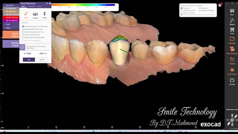 #design #naildesign #dental #dentaldesign #exocadexpert