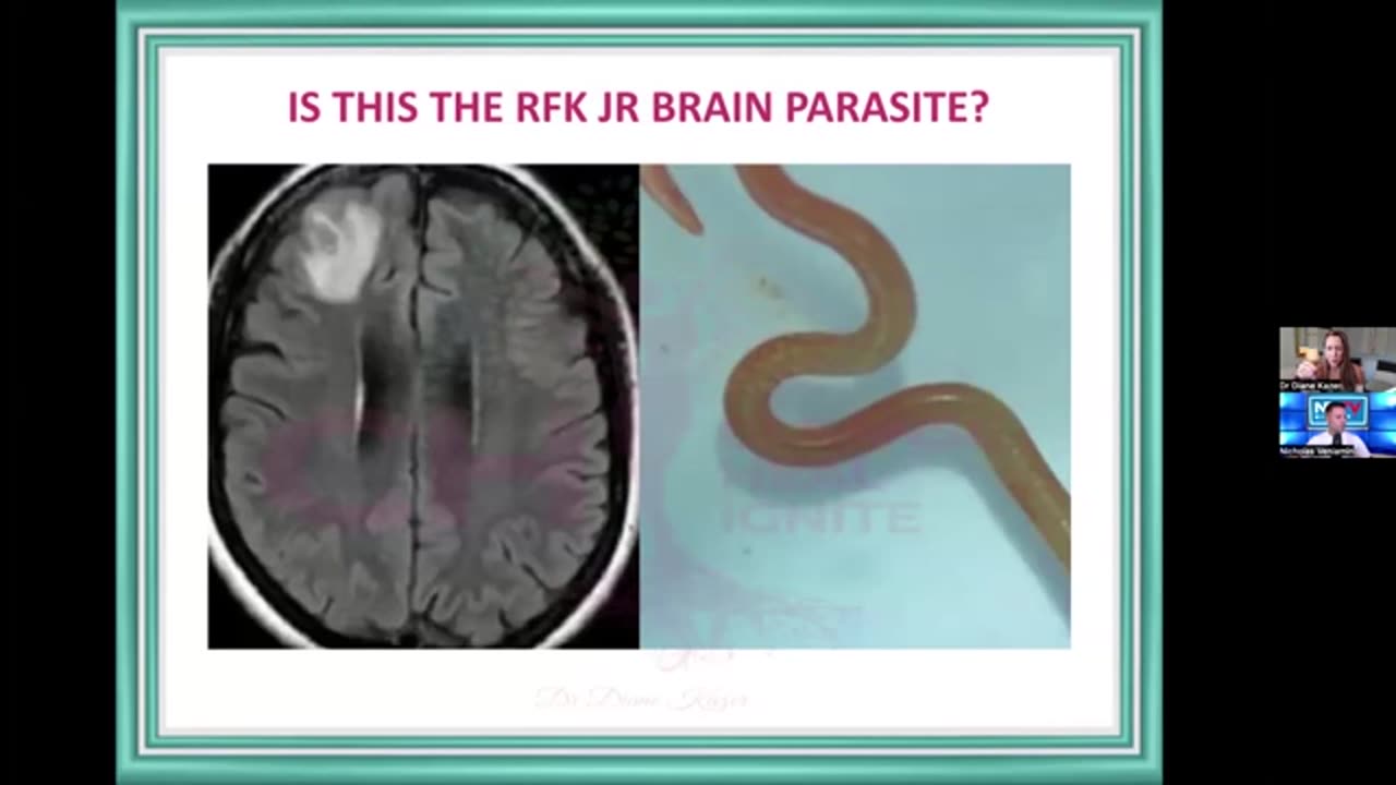 RFK Jr.'s Reported Brain Parasite: Dr. Diane Kazer Discusses with Nicholas Veniamin