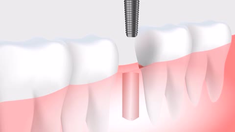 Dental installation method - medical - dentistry