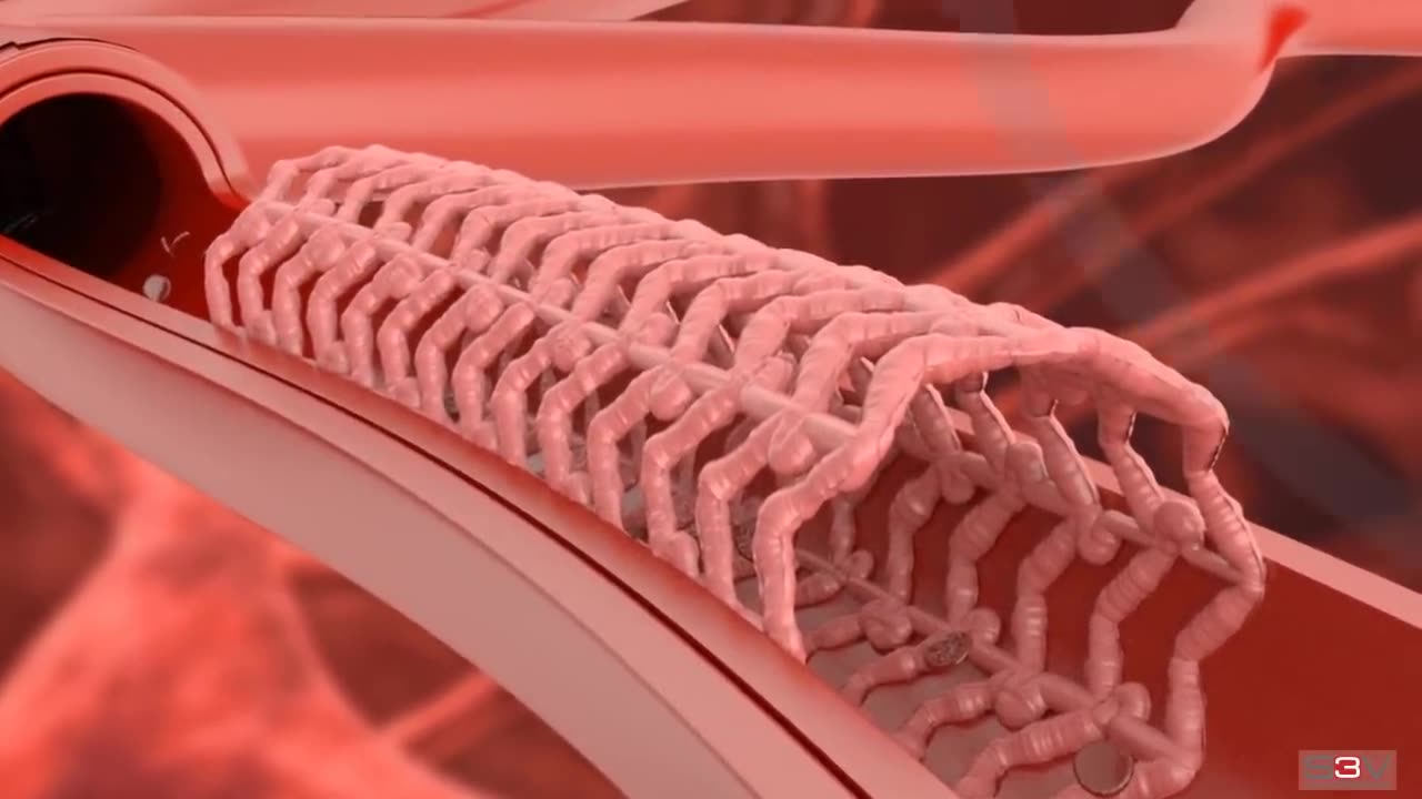 Angioplasty - Medical animation