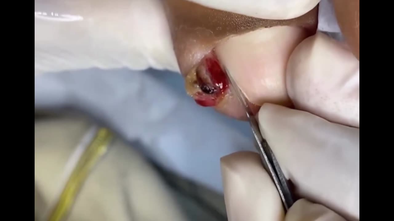 Ingrown toenail removal 006