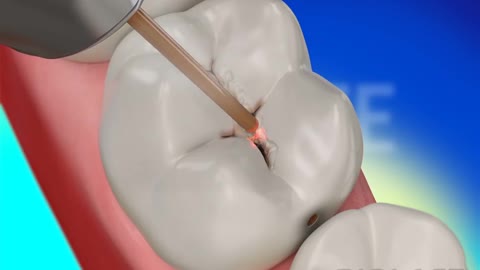 Animated Dental Restoration Operation