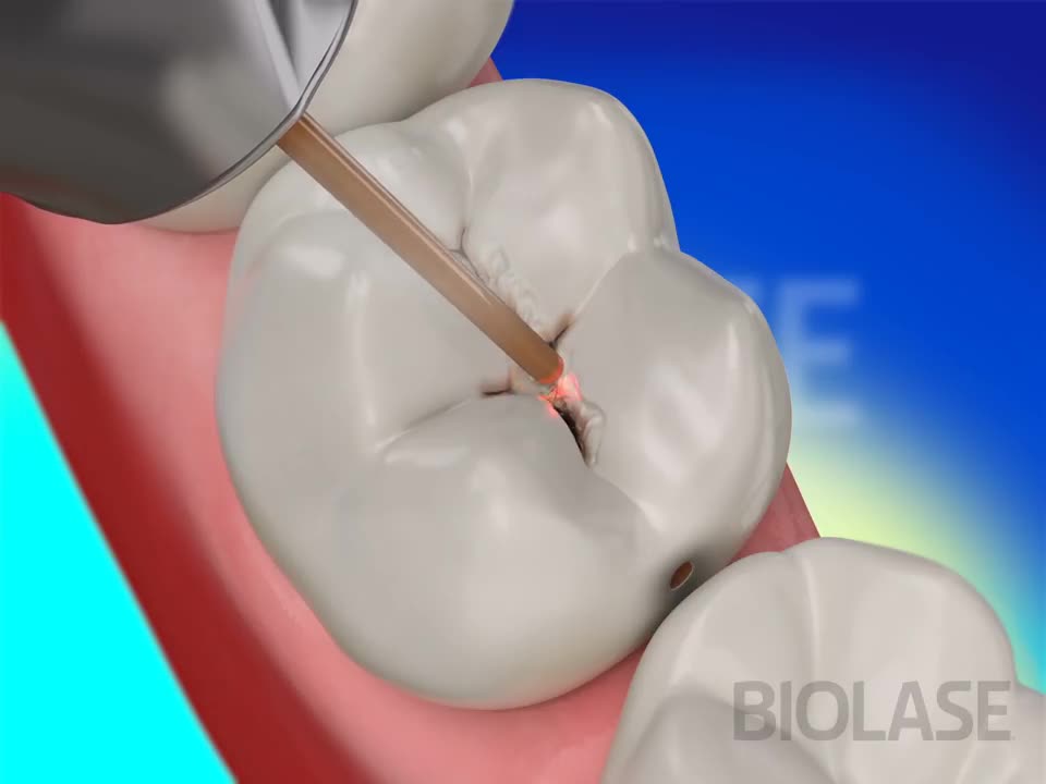 Animated Dental Restoration Operation