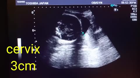Gender Determination (Difficult and Female) at 20 Week Age