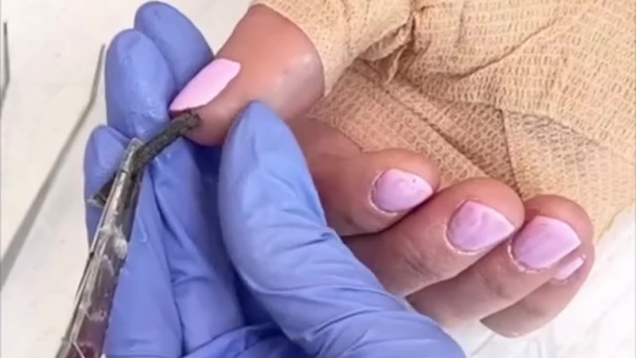 Stranger Material Removed From Women’s Finger 💅 😱😳😭