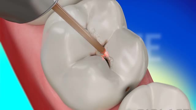 Dental Restoration with Waterlase Laser Dentistry