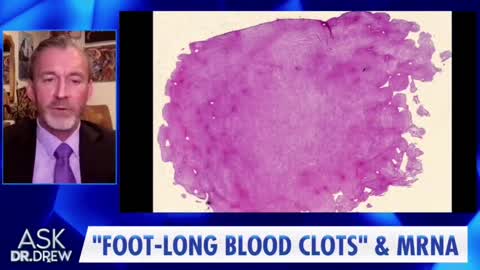 Dr. Ryan Cole - Blood Clots