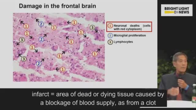 Spike proteins in the capillaries of the brain ~ presented by the fantastic Dr. Sucharit Bhakdi.