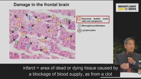 Spike proteins in the capillaries of the brain ~ presented by the fantastic Dr. Sucharit Bhakdi.