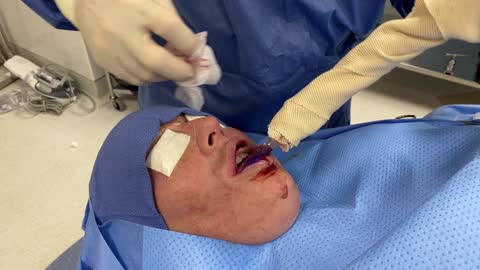 Surgical Removal of Illegal Silicone Injections from the Upper and Lower Lips