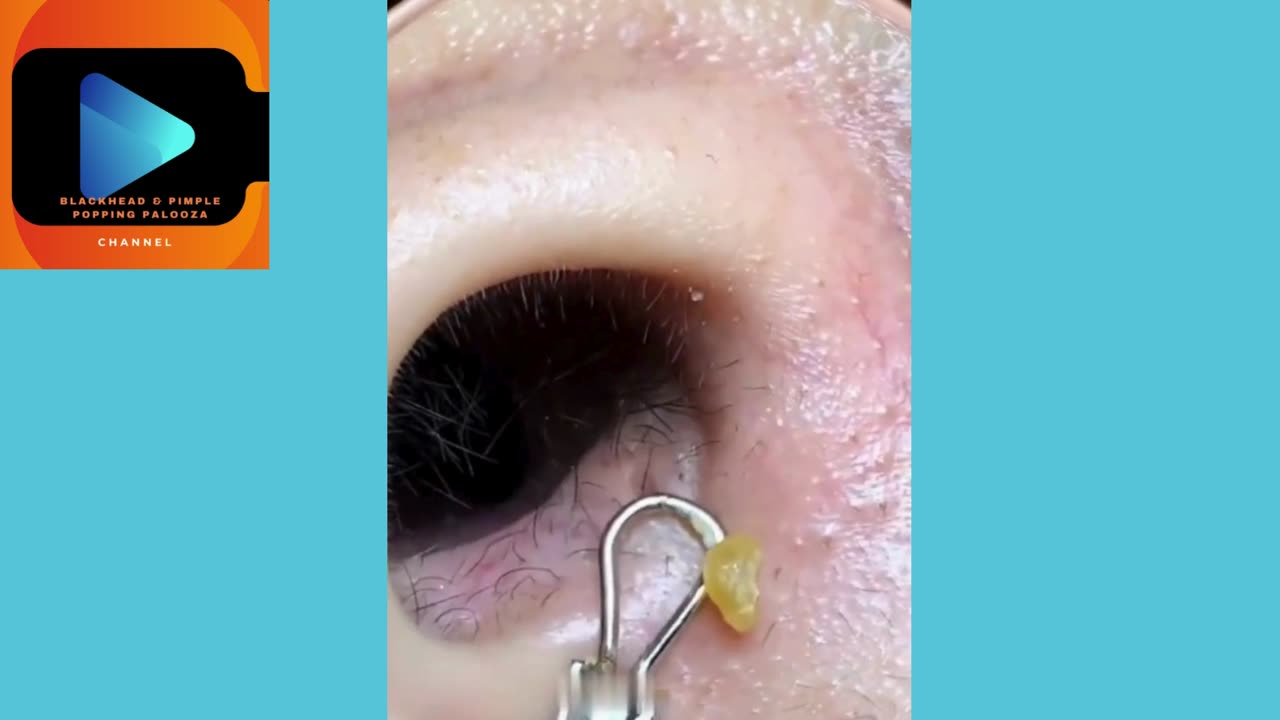 The Great Nose Pimple Extraction