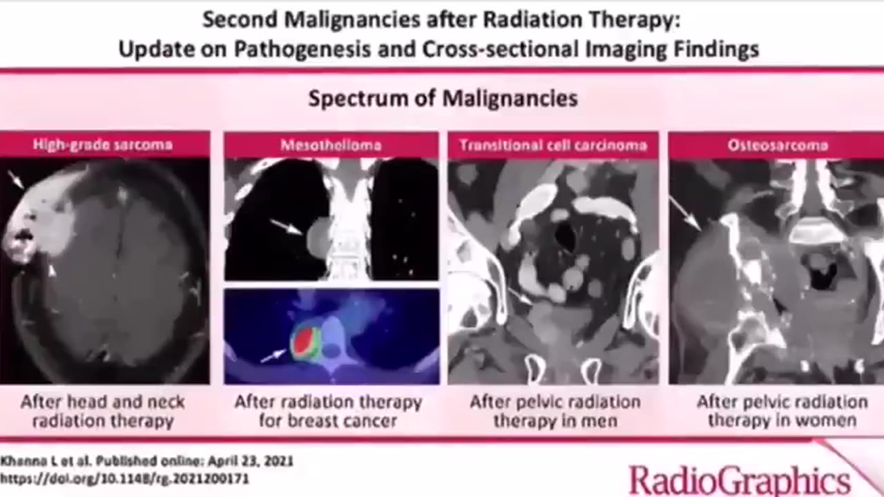 Nanocapsels-What is in the jab?