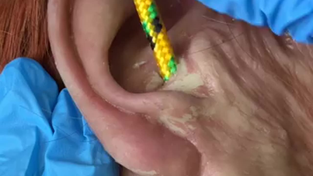 Ear treatment