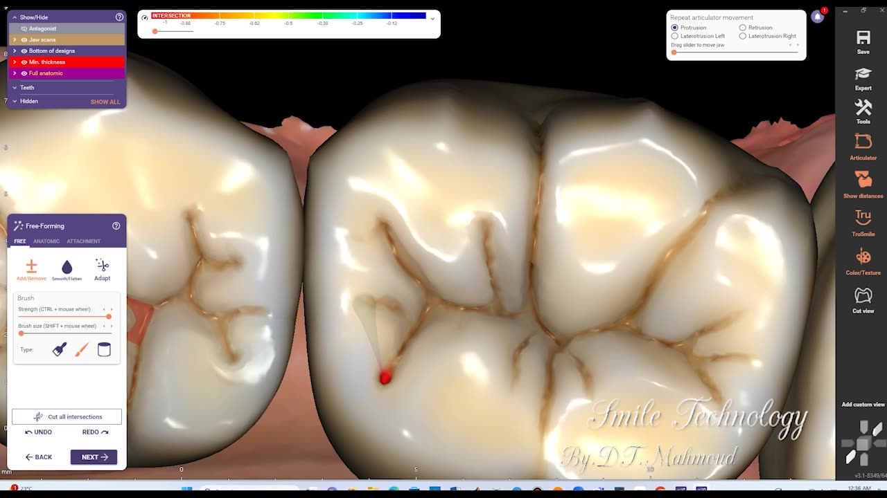 #design #naildesign #dental #dentaldesign #exocadexpert