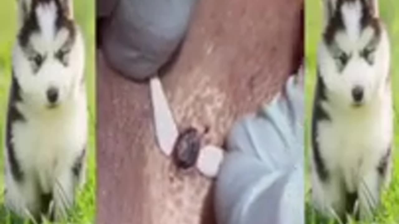 Pimple Popping 2021 - Blackheads & Whiteheads
