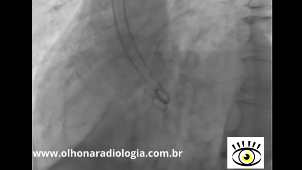 AORTOGRAFIA E VENTRICULOGRAFIA - Olho na Radiologia