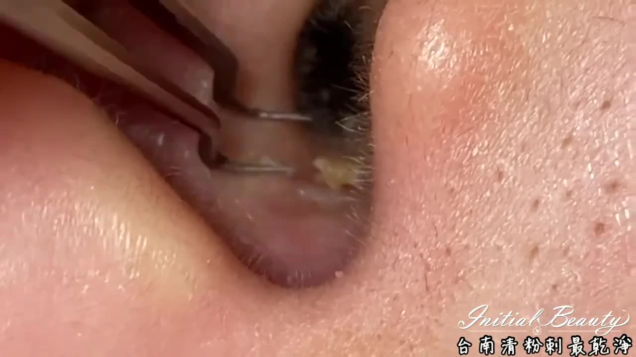 Blackhead Removal