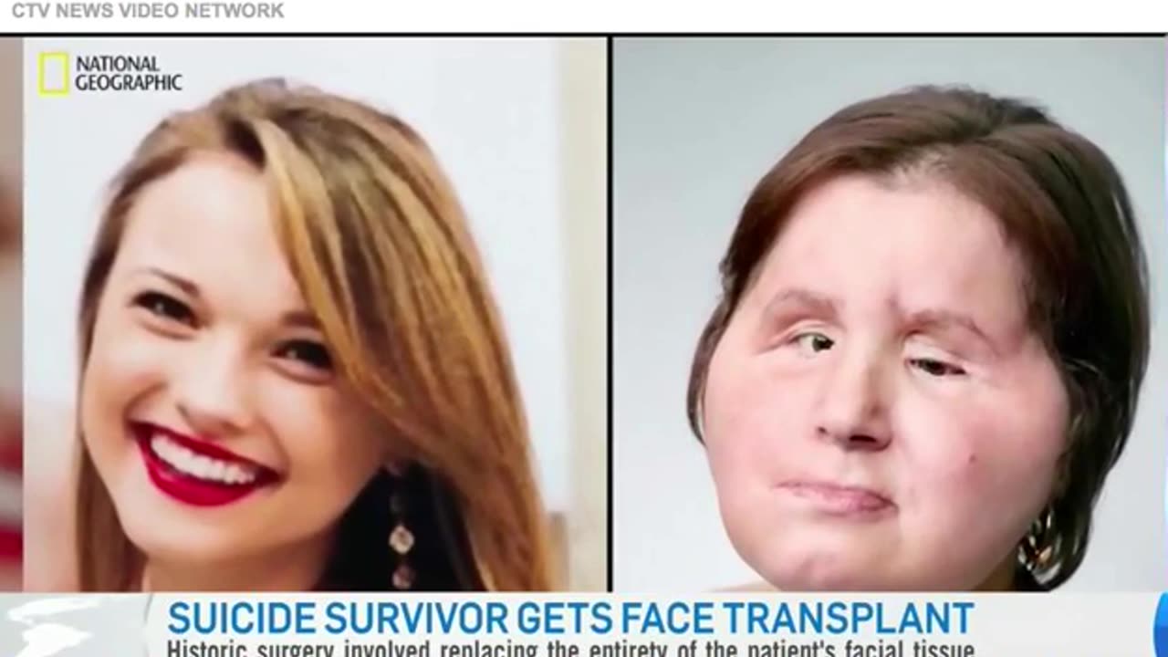 Face Transplant by Dr Gaby Doumit