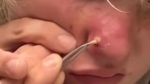 ACNE poPpINg 2021 | Cyst