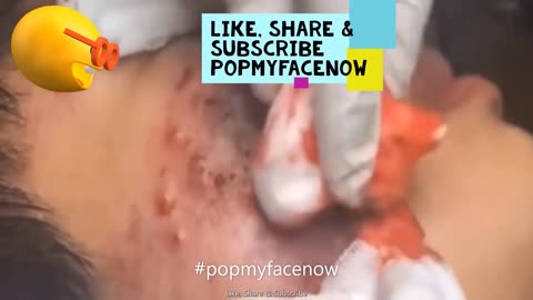 BEST INFECTED ACNE BLACKHEAD REMOVAL PART 3 🤓 🤯 EXPLOSION💯💥 #popmyfacenow #bestacneinfection