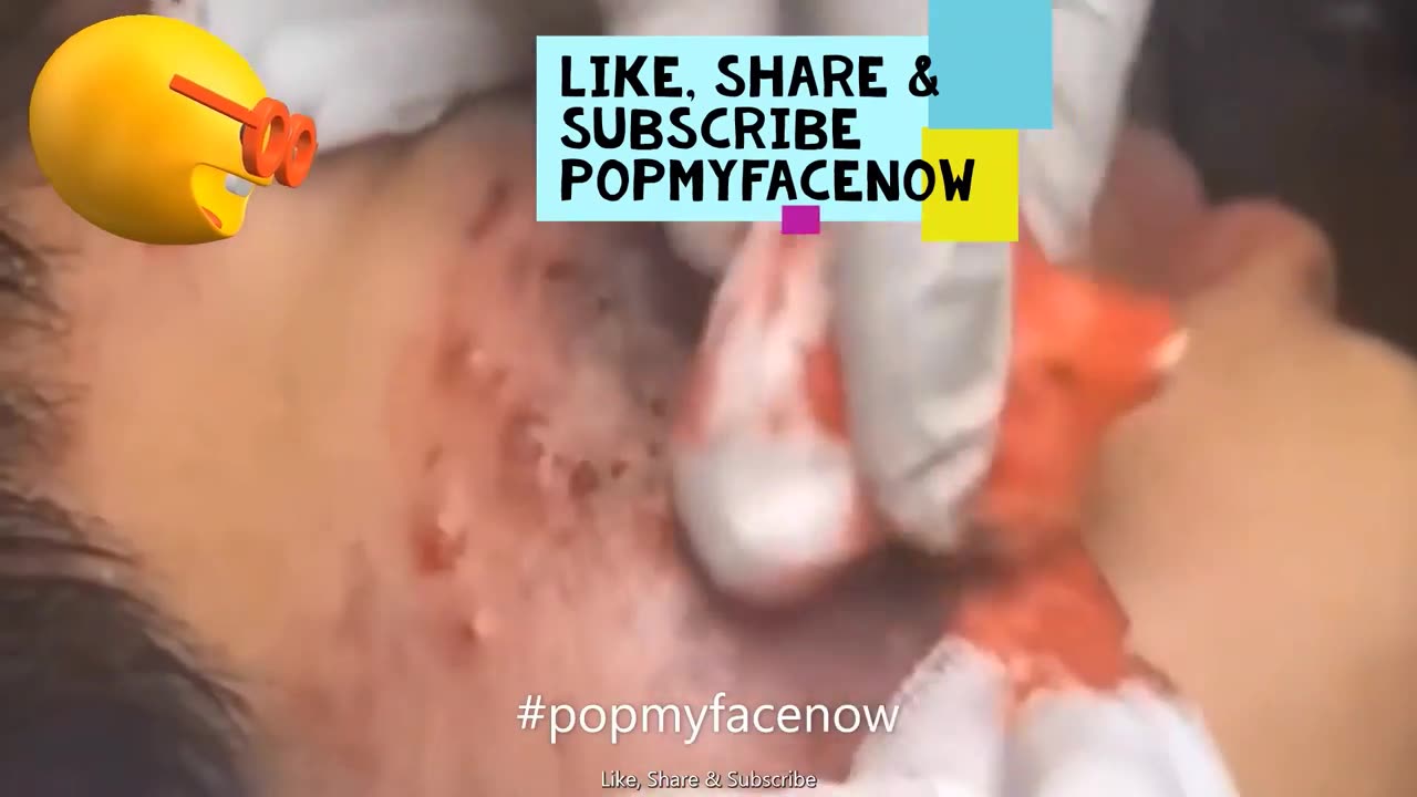 BEST INFECTED ACNE BLACKHEAD REMOVAL PART 3 🤓 🤯 EXPLOSION💯💥 #popmyfacenow #bestacneinfection