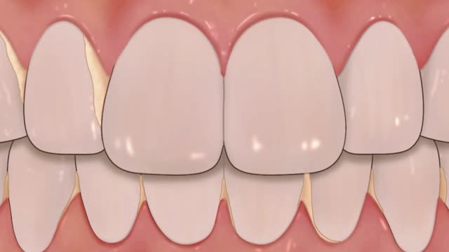 [ASMR] teeth scaling and tartar removal animation
